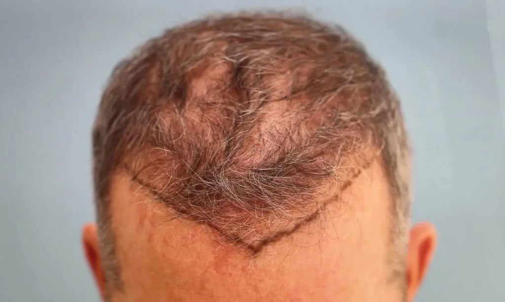 Advance Hair Clinic