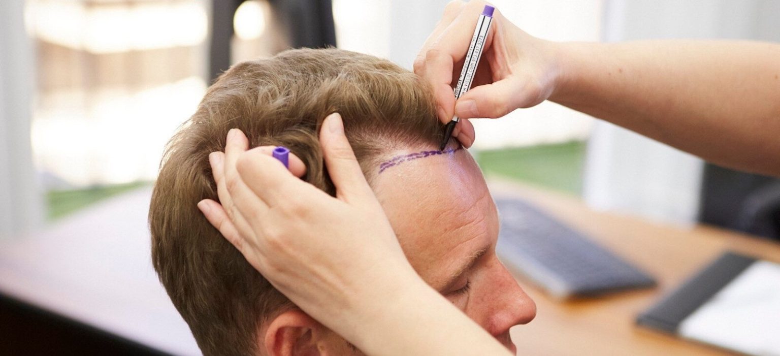 أفضل عيادات زراعة الشعر في دبي
