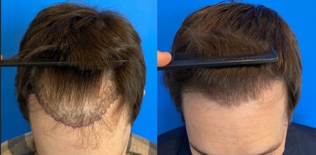 Hair Restoration